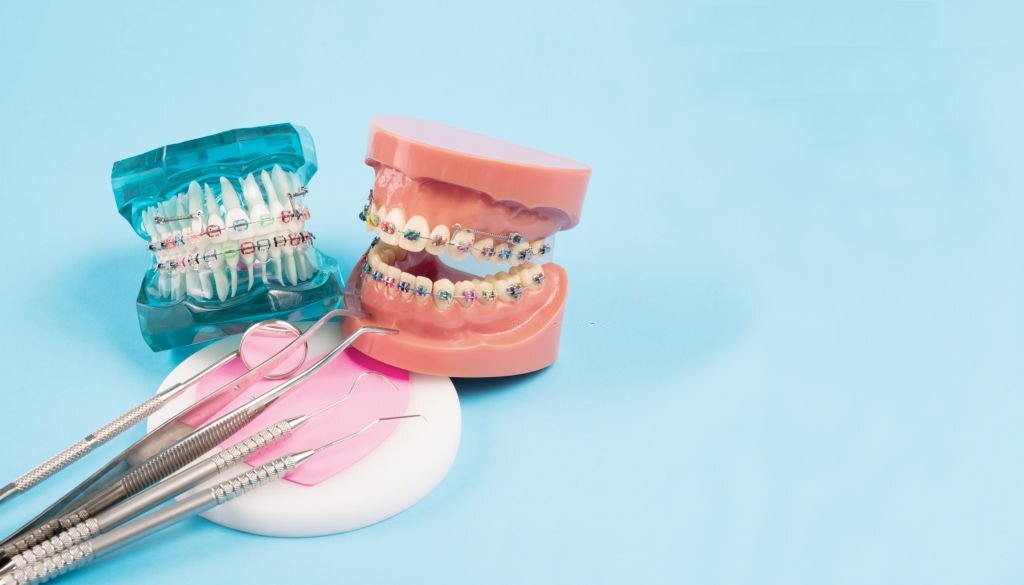 Read more about the article How long do traditional braces take?