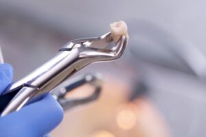 Read more about the article How long does it take for a wisdom tooth extraction to recover?