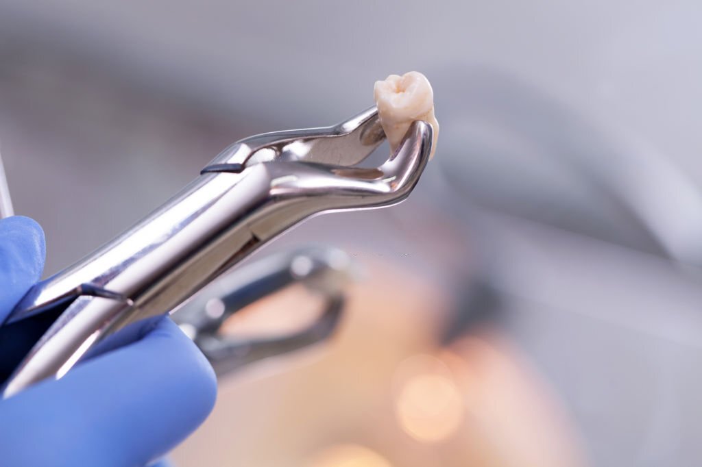 You are currently viewing How long does it take for a wisdom tooth extraction to recover?