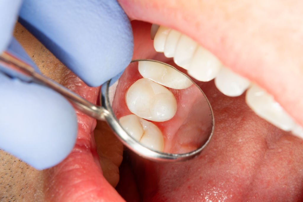 You are currently viewing How long will root canal treatment last?